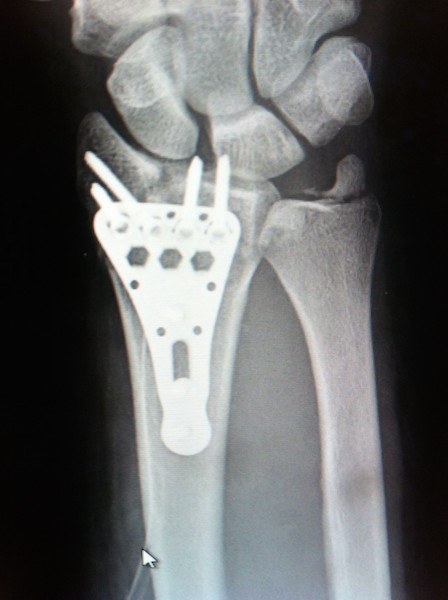 Königsee Distal Radius Plate (Implant 170208)